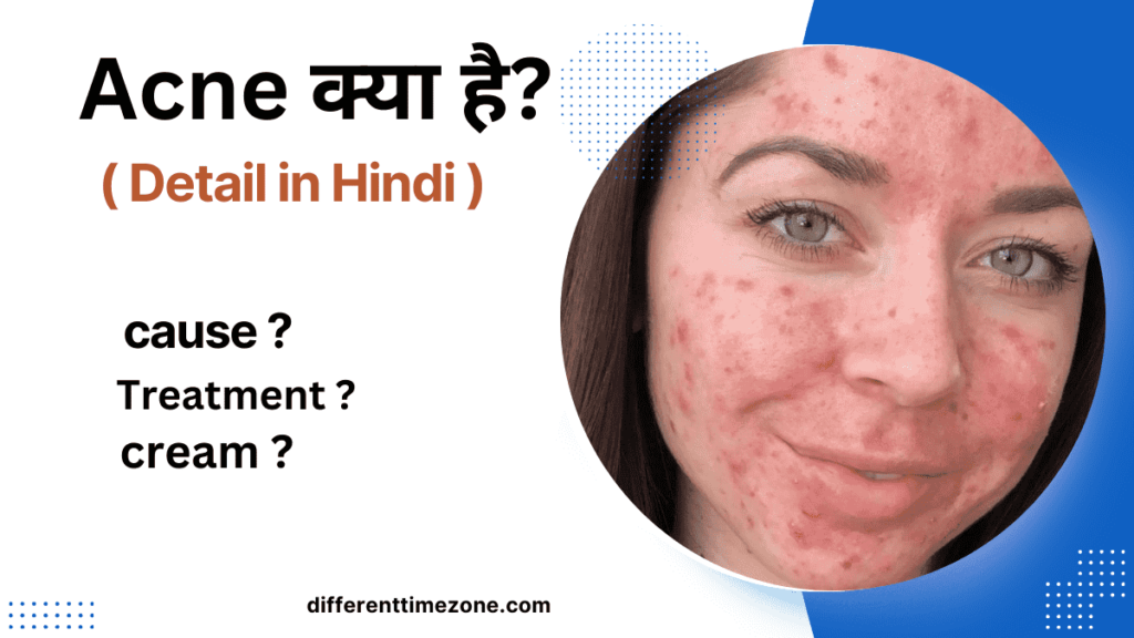 Acne kya hai explain in hindi (Acne क्या है?)2024