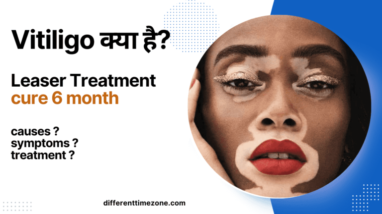 Vitiligo in Hindi & Top Leaser Treatment 2024