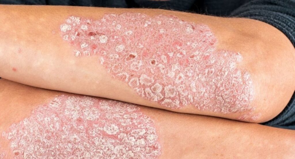 Psoriasis क्या है?