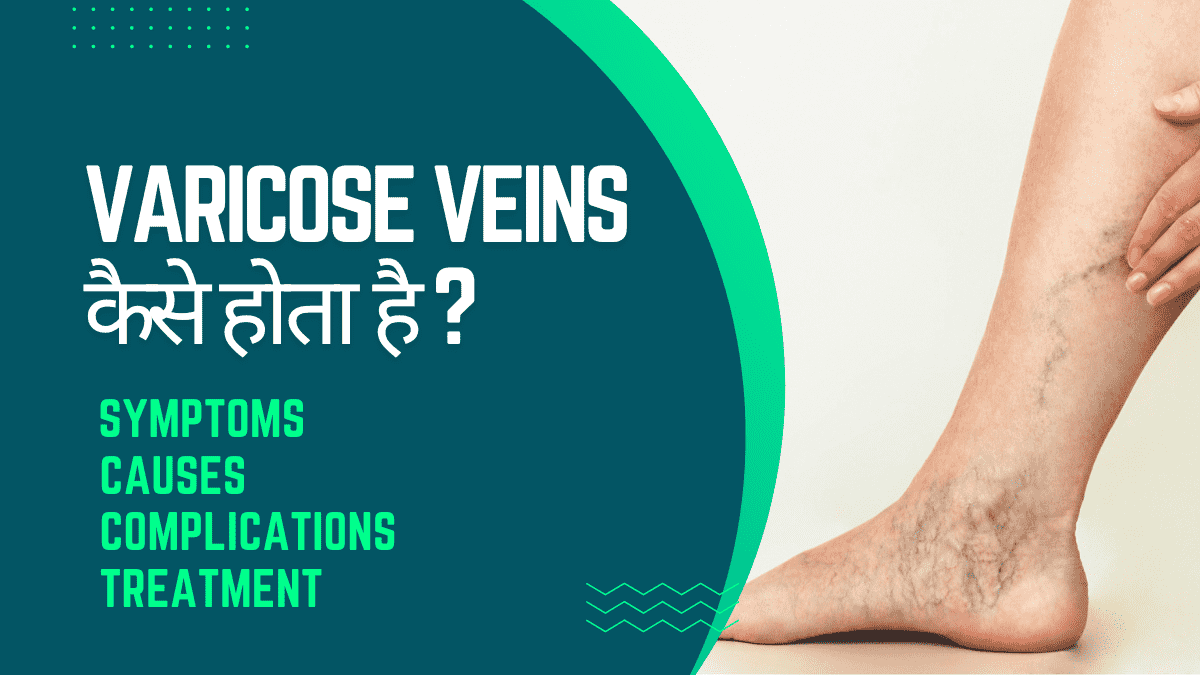 वेरिकोस varicose vain क्या है ?